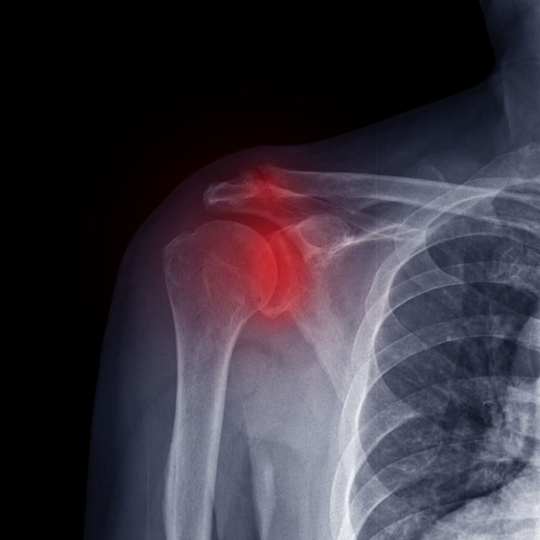 X-ray of the shoulder with the acromioclavicular joint highlighted, showing where AC joint injury pain is felt at the top of the shoulder